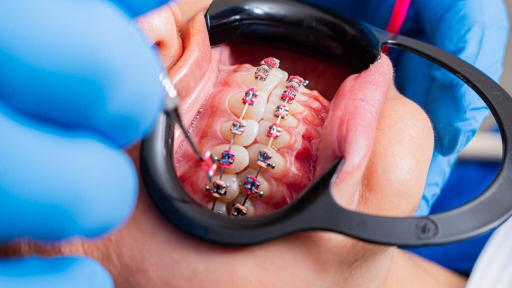 Clear Aligners vs. Metal Braces: Which Works Best for College Students & Working Pros?