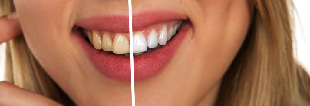 Dental Hospital In Erode For Teeth Whitening