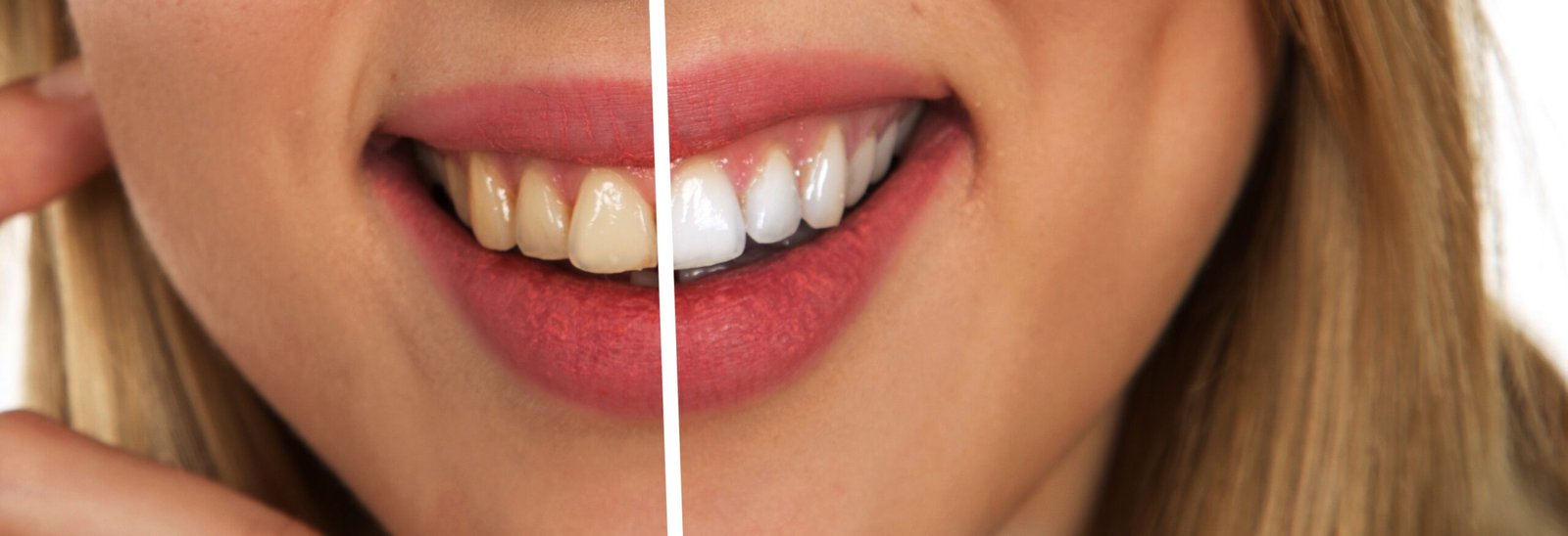 Dental Hospital In Erode For Teeth Whitening