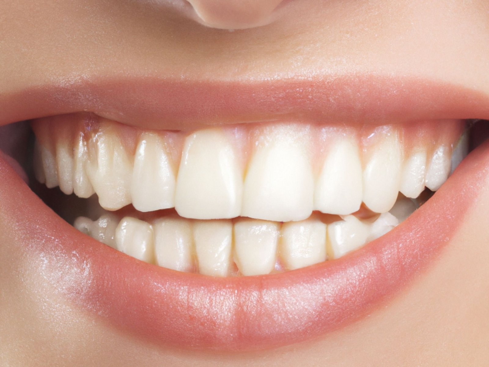 The 48-Hour Wedding Smile Transformation: How We Restored Rajesh’s Broken Front Tooth